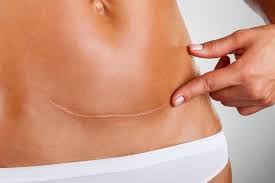 ουλη από καισαρικη